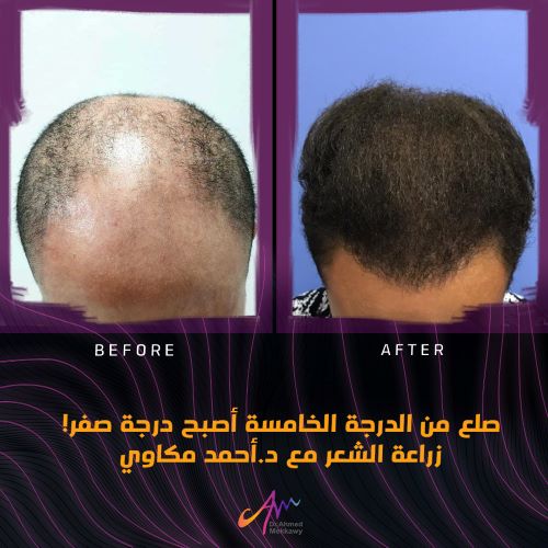 افضل دكتور زراعة شعر في العالم